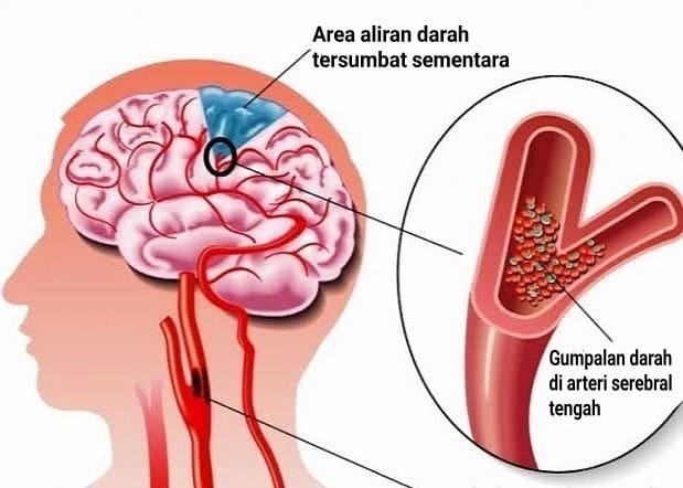 selasa-stroke4